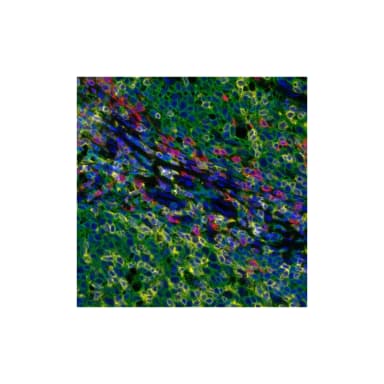 Tumor Infiltrating Lymphocyte (TIL) PathPlex® Panel (CD3E, CD8 alpha, CD20)